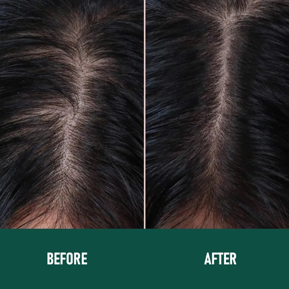 CH004 5% minoxidil anti-hair loss mousse 60ml canister with pump applicator on white background.