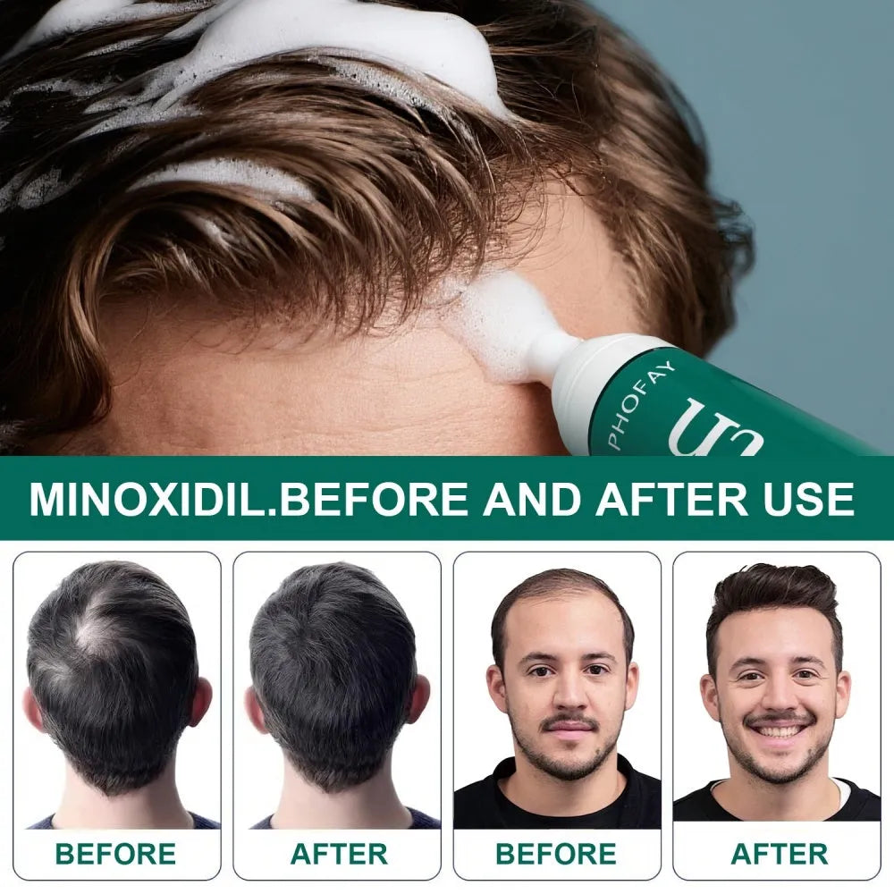 CH004 5% minoxidil anti-hair loss mousse 60ml canister with pump applicator on white background.