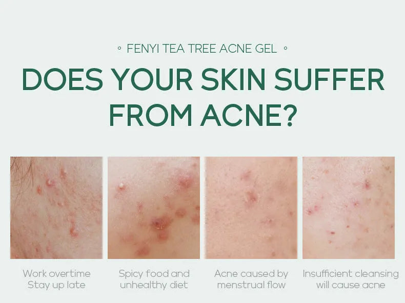 20g moisturising skin care product tube with acne medicine tea tree oil and aloe extract