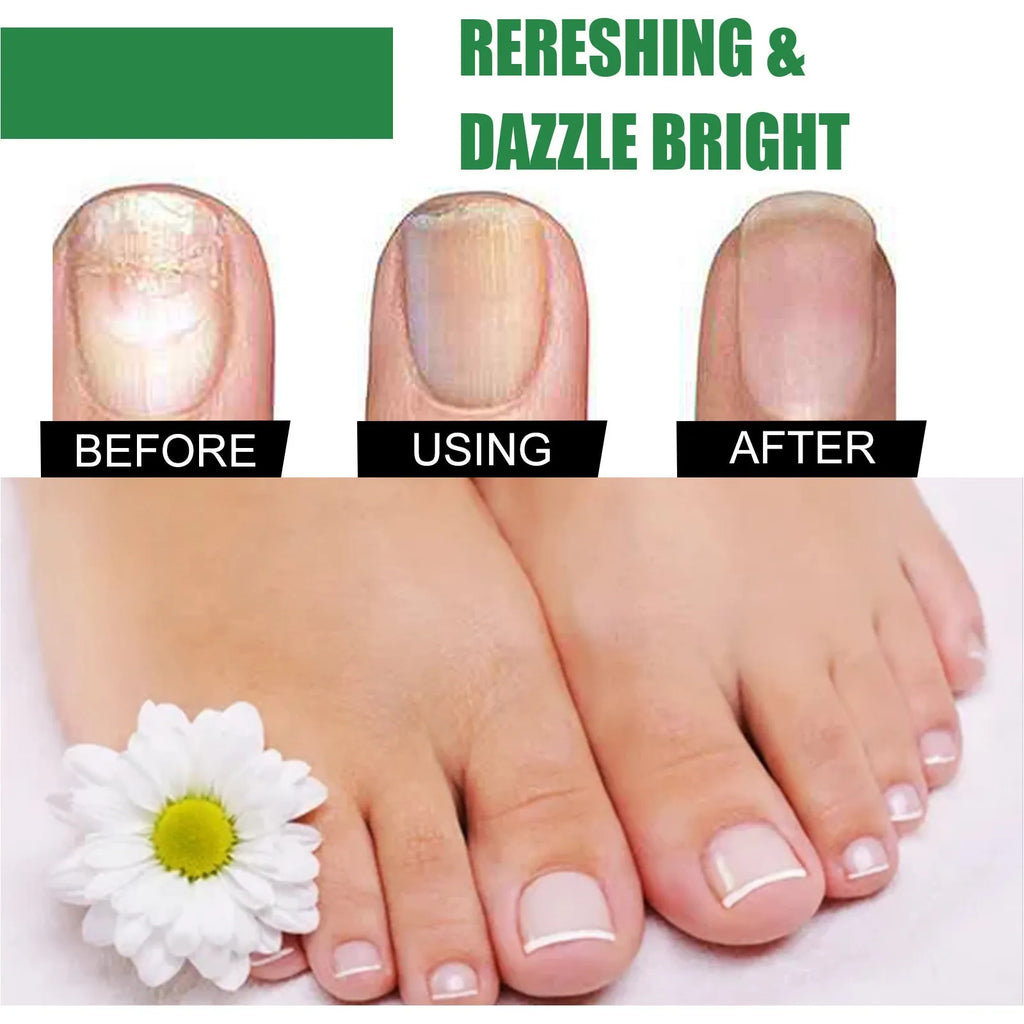 30ml bottle of Tea Tree Oil foot nail care repair fluid for thick nails