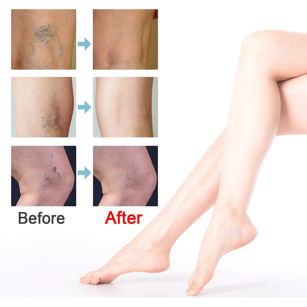 20g tube of vein repair cream for leg vein relief and bulge treatment.