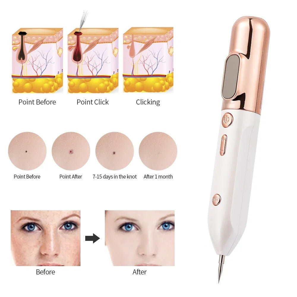 Blue light acne beauty instrument removal pen set with cooling gel and needles on a table