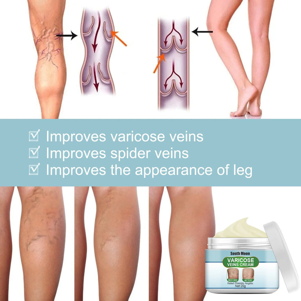 20g tube of vein repair cream for leg vein relief and bulge treatment.