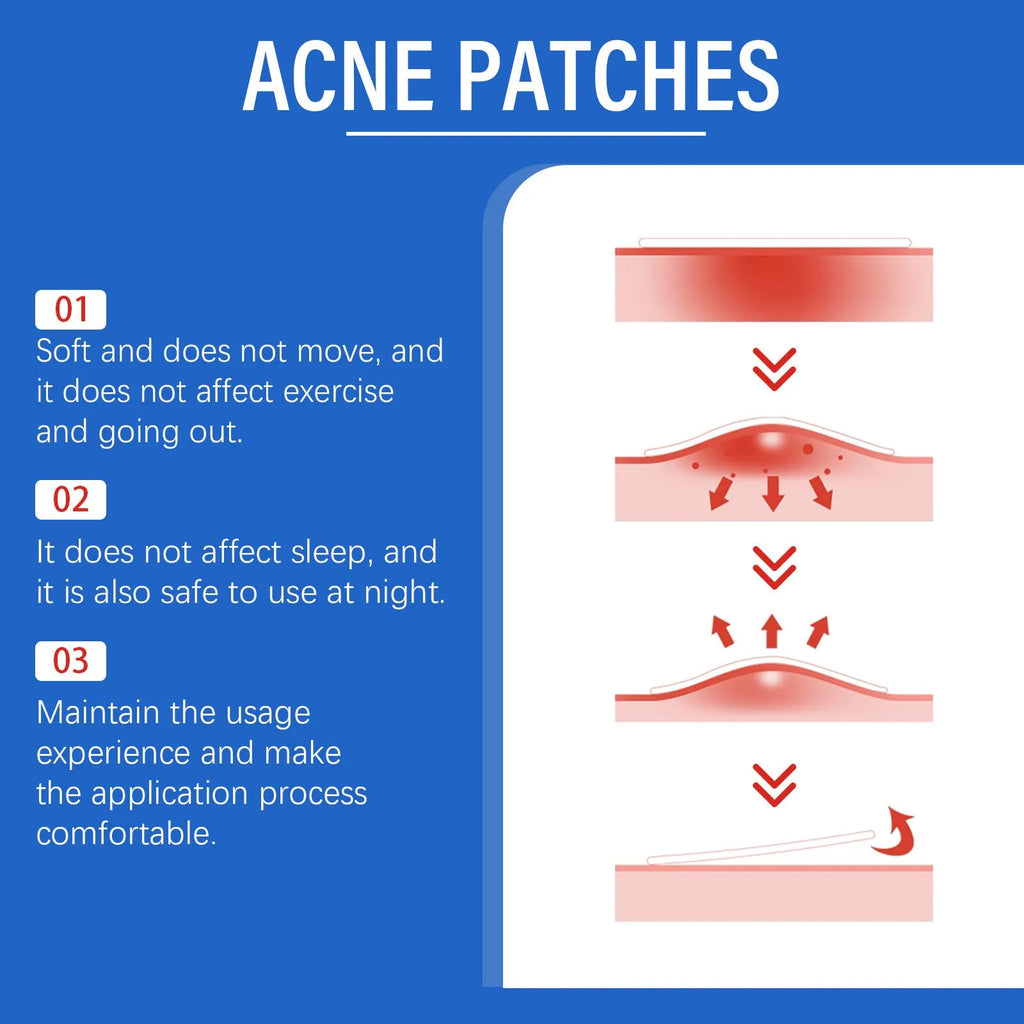 216 tea tree oil and vitamin E hydrocolloid acne patches for facial blemish treatment