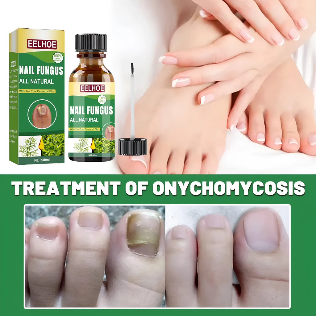 30ml bottle of Tea Tree Oil foot nail care repair fluid for thick nails
