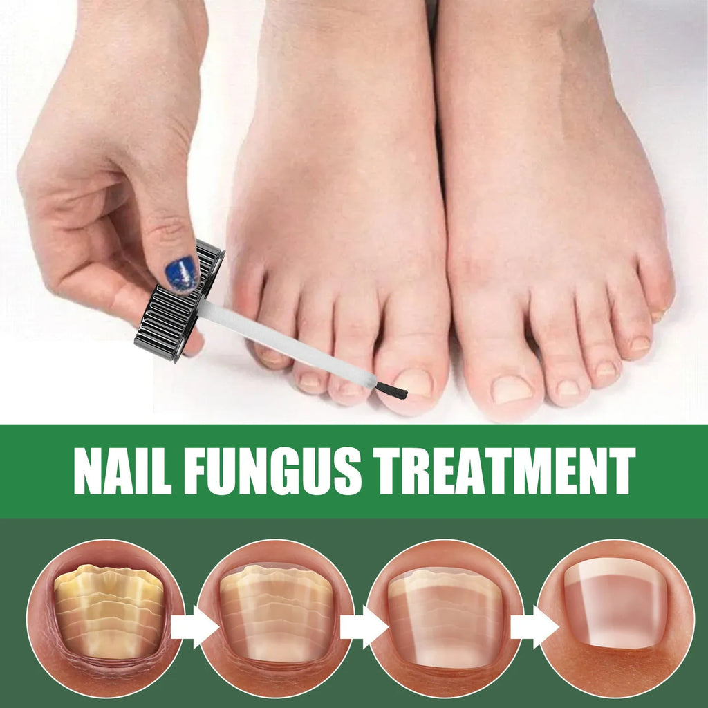 30ml bottle of Tea Tree Oil foot nail care repair fluid for thick nails